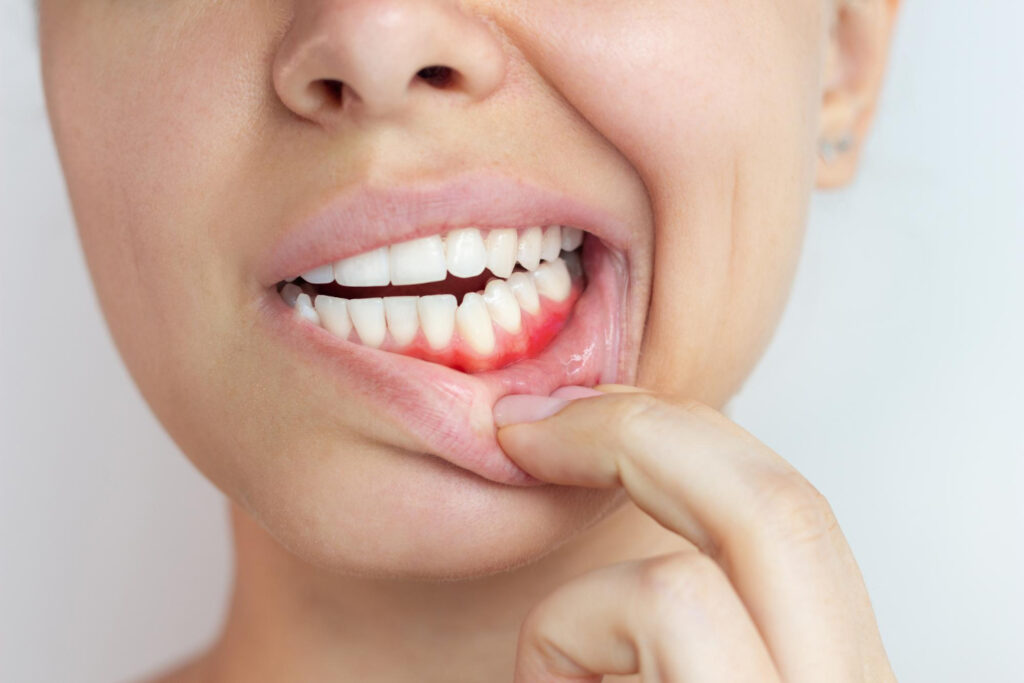 Gum disease - periodontics